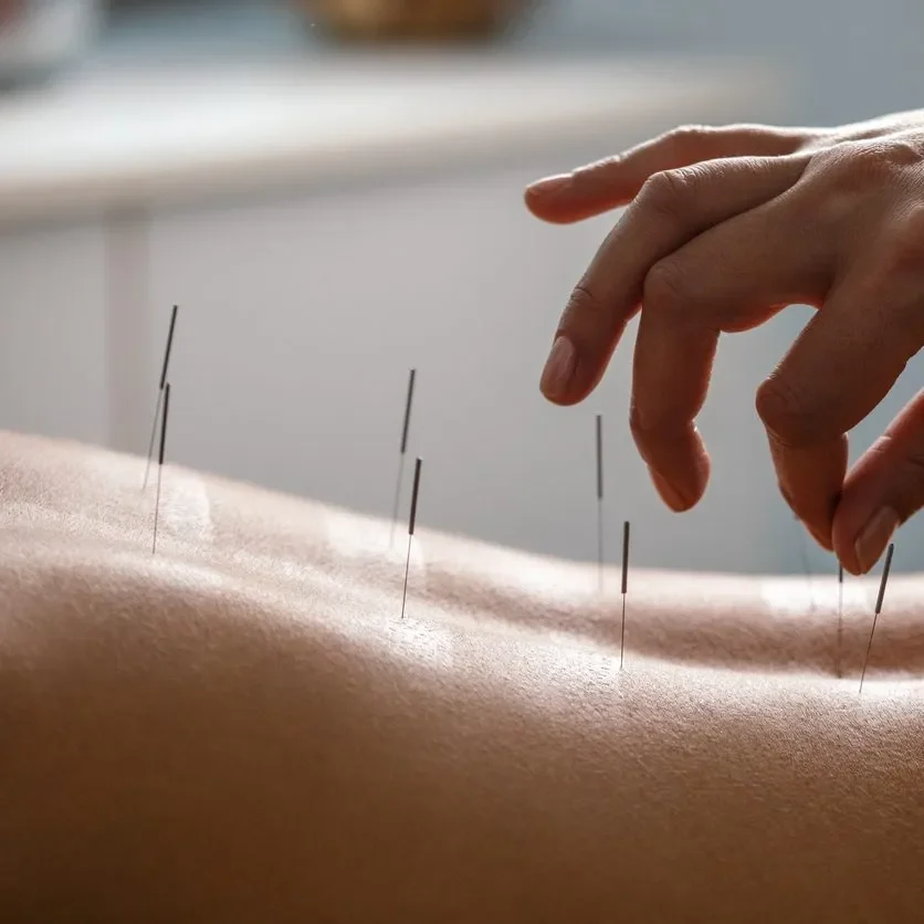 Sessão de Acupuntura